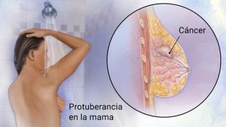analisis cancer prostata tegucigalpa Centro De Cáncer Emma Romero De Callejas